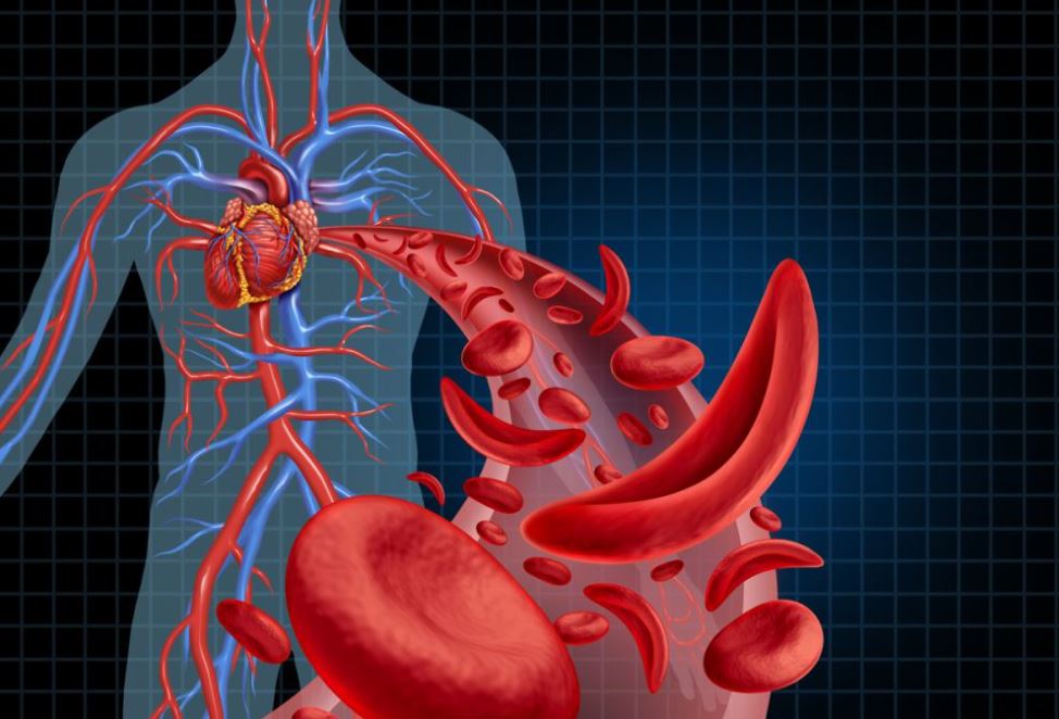  علاجين لمرض فقر الدم المنجلي يعطي آملًا لآلاف المرضى تمت الموافقة عليهما 