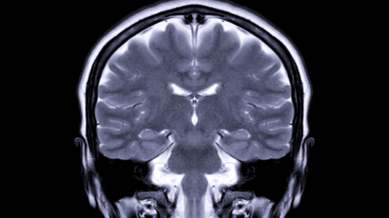 تصوير المخ بالرنين المغناطيسي